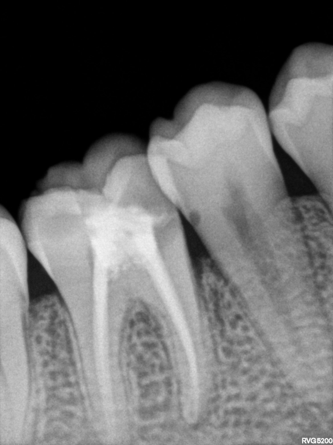 Dental X-ray